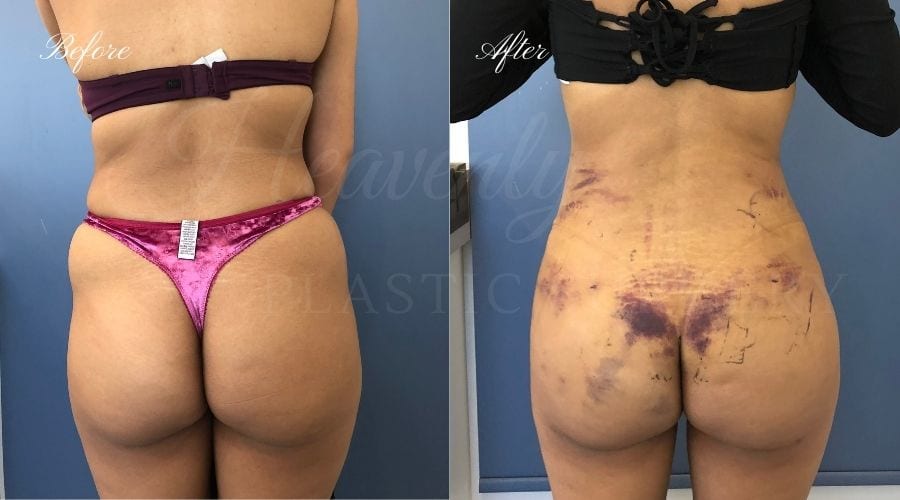 Brazilian Butt Lift - Heavenly Plastic Surgery