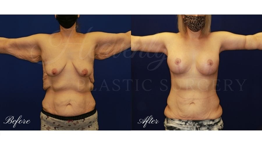 8 months post op from tummy tuck with muscle repair and a breast