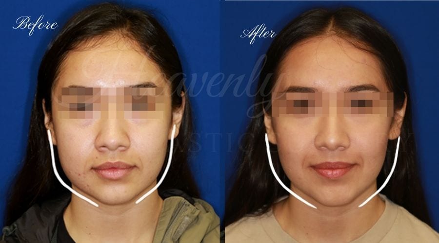 Buccal Fat Pad Removal (Cheek Fat Removal) - Heavenly Plastic Surgery