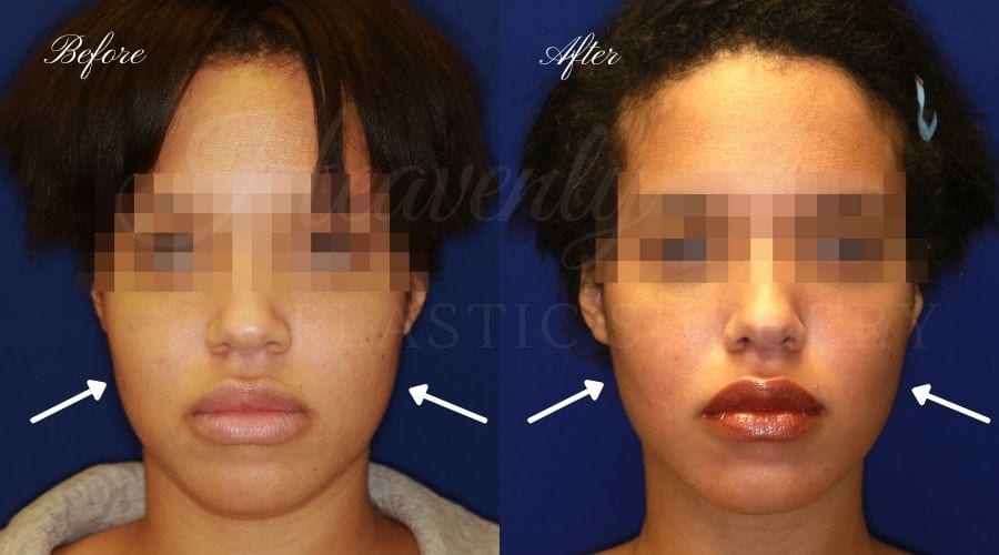 Buccal Fat Pad Removal Before and After Gallery - Heavenly Plastic