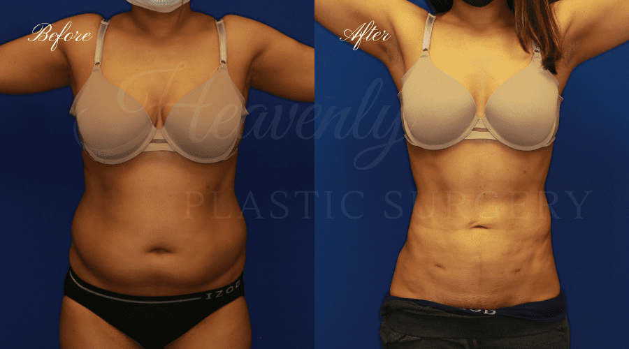 Liposuction & Lipoetching Gallery - Heavenly Plastic Surgery
