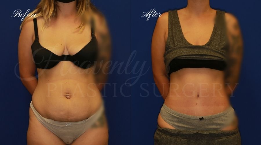 Finn Plastic Surgery - ✨ BEFORE & AFTER ✨ 📝 Tummy tuck with flank  liposuction 📸 6 months post-op This mom of 3 is thrilled with her results!  🤩 A tummy tuck